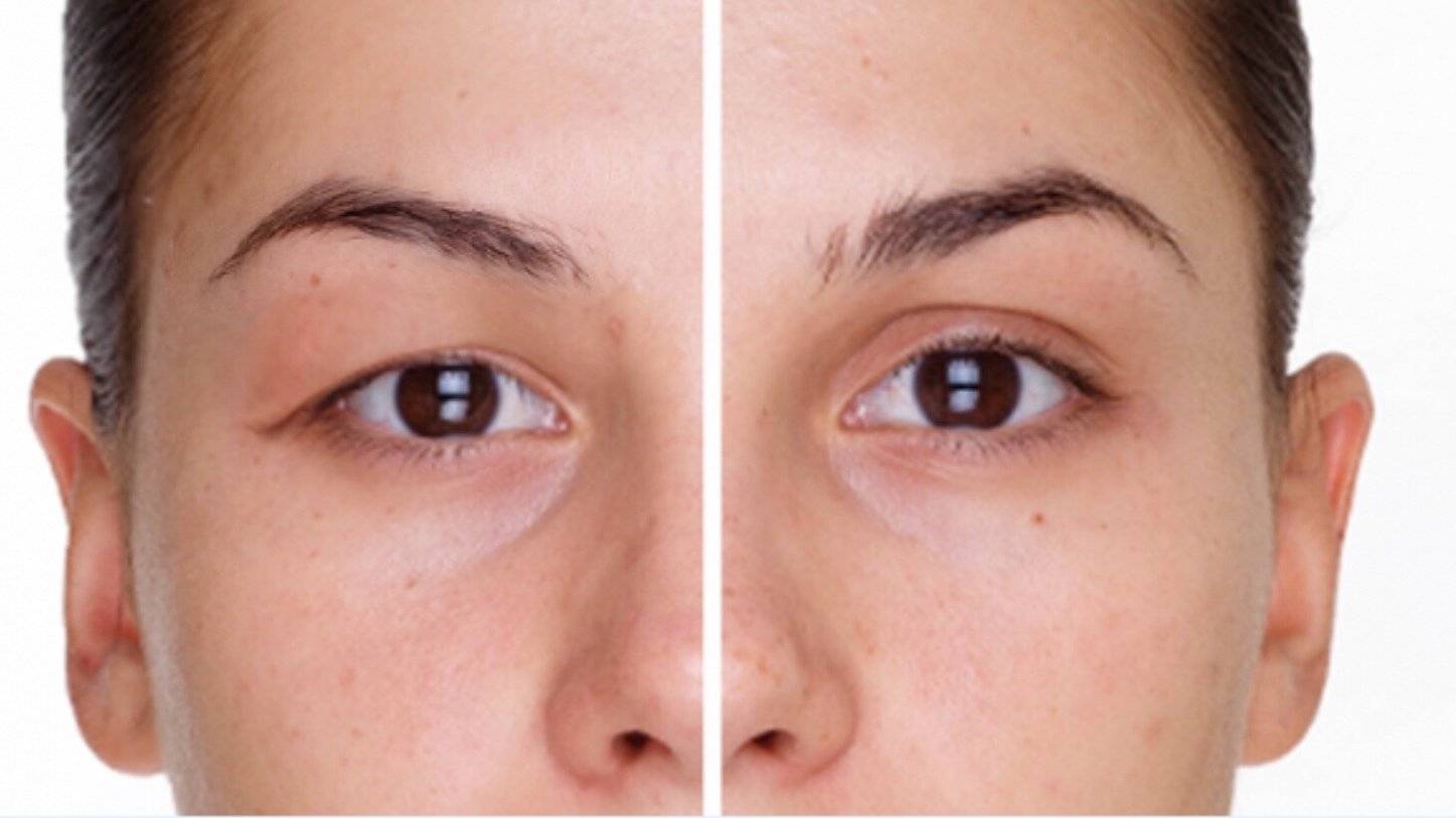 dr akyol goz kapaklarindaki sarkmalar gorme guclugune yol acabiliyor GsCY3mZG